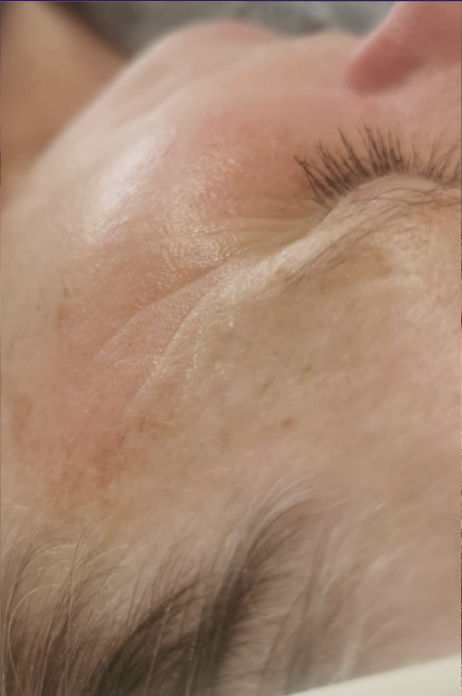 Microneedling after
