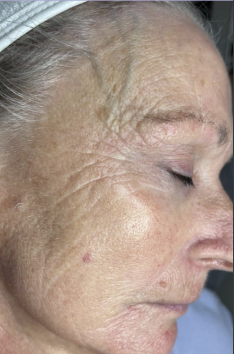 Microneedling after