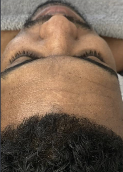 Microneedling before